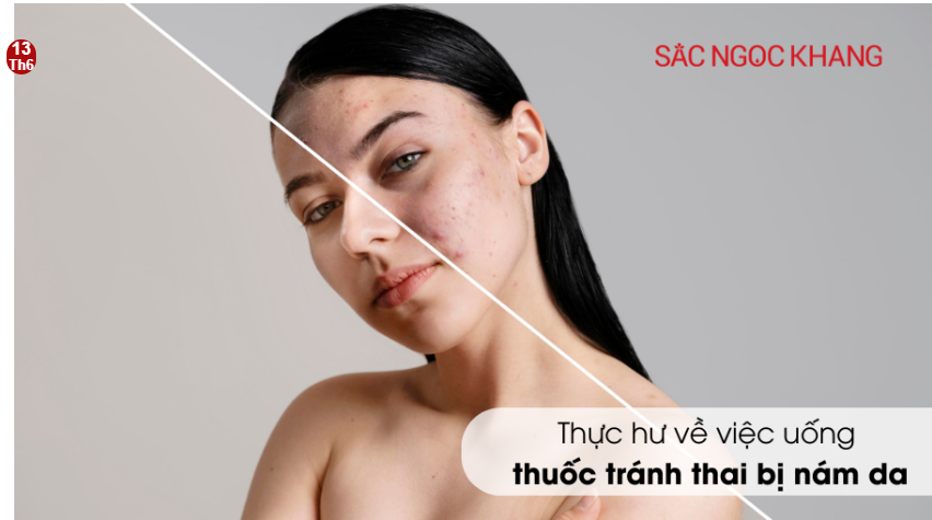 Thực hư về việc uống thuốc tránh thai bị nám da